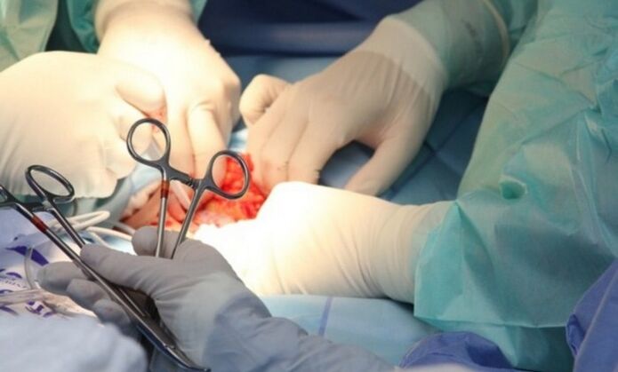 Ligamentotomie – chirurgie pour agrandir le pénis
