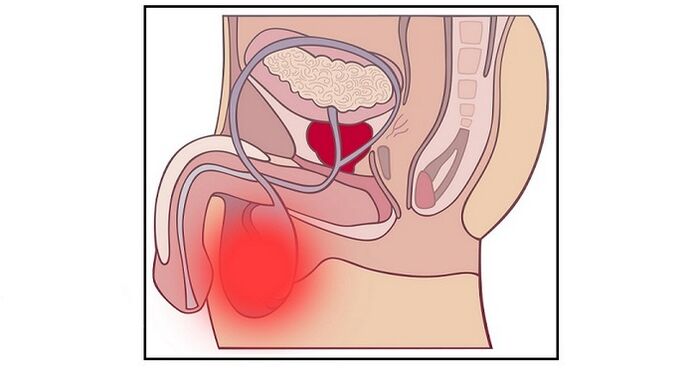 Une complication de la chirurgie d’agrandissement du pénis peut être une inflammation des testicules. 